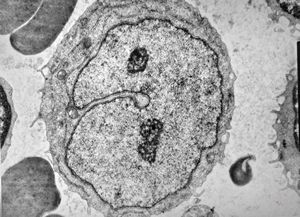 M,71y. | blood - blastic elements